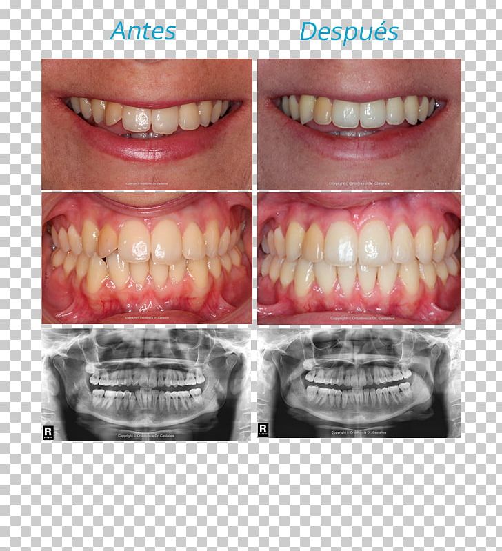 Tooth Orthodontics Malocclusion Dr. Castaños Ortodoncia Incisor PNG, Clipart, Bilbao, Cosmetic Dentistry, Elasticity, Incisor, Jaw Free PNG Download