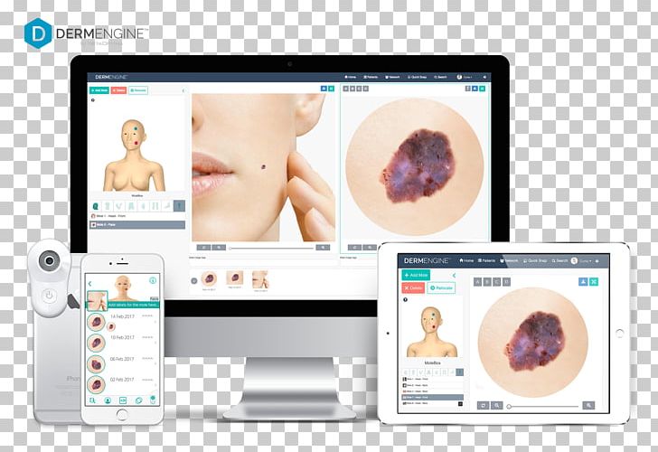 Skin Cancer Teledermatology Dermatoscopy MetaOptima Technology Inc. PNG, Clipart, Dermatology, Dermatoscopy, Education, Electronics, Eyelash Free PNG Download