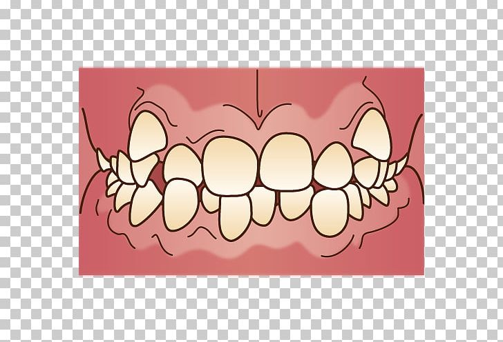 Dental Braces 矯正歯科 Dentist Mouthguard PNG, Clipart, Clear Aligners, Crowding Of Teeth, Dental Braces, Dentist, Dentition Free PNG Download