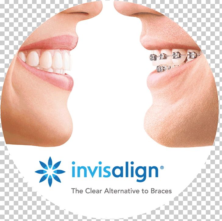 Clear Aligners Dental Braces Orthodontics Dentistry Retainer PNG, Clipart, Chin, Clear Aligners, Cosmetic Dentistry, Damon System, Dental Braces Free PNG Download