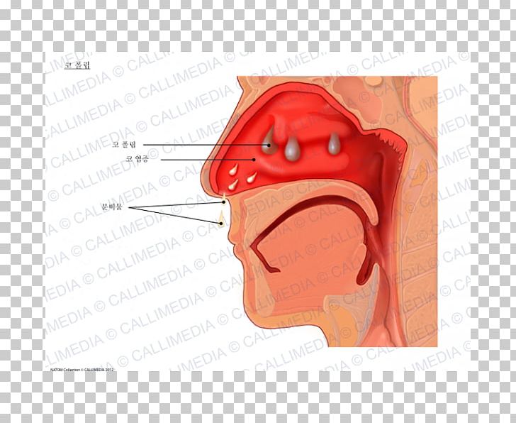 Hay Fever Nasal Polyp Rhinitis Allergy PNG, Clipart, Allergy, Cartoon, Cheek, Chin, Common Cold Free PNG Download