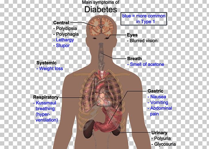 Diabetes Mellitus Type 2 Disease Human Body Type 1 Diabetes PNG, Clipart, Abdomen, Adverse Effect, Ageing, Arm, Autoimmune Disease Free PNG Download