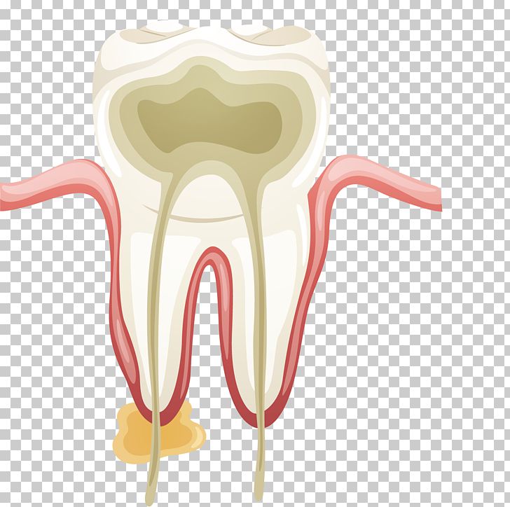 Dentistry Root Canal Tooth Endodontics Endodontic Therapy PNG, Clipart, Abstract Art, Art Deco, Decay, Dental Surgery, Font Free PNG Download