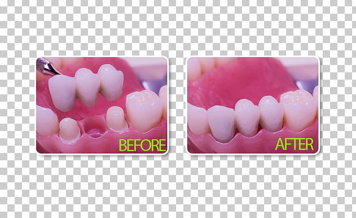 Bridge Dentistry Dental Implant Crown PNG, Clipart, Bridge, Crown, Dental Implant, Dental Restoration, Dental Surgery Free PNG Download