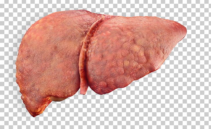 Alcoholic Liver Disease Cirrhosis Fatty Liver PNG, Clipart, Animal Source Foods, Beef, Disease, Liver, Liver Cancer Free PNG Download