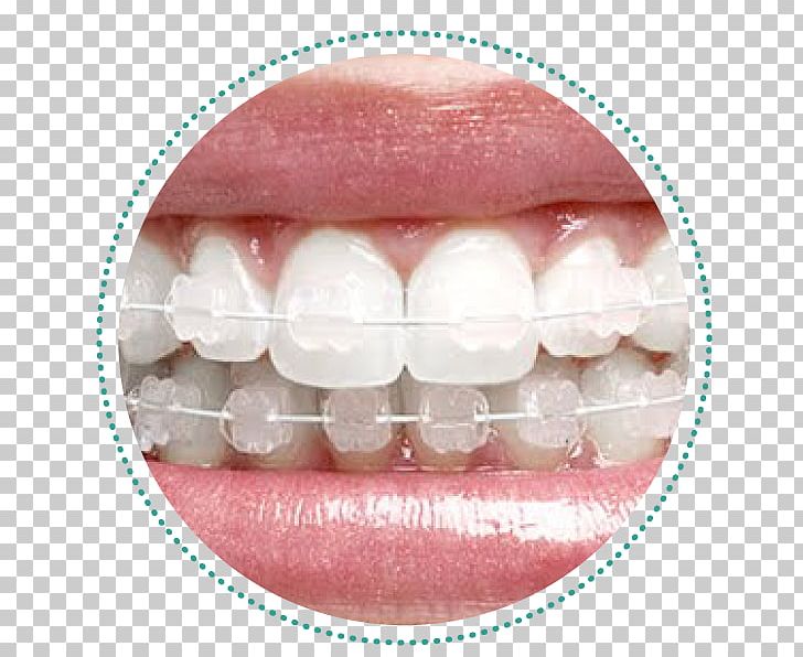 Dental Braces Orthodontics Dentistry Tratamento PNG, Clipart, Bracket, Clinica, Cosmetic Dentistry, Dental Braces, Dental Implant Free PNG Download