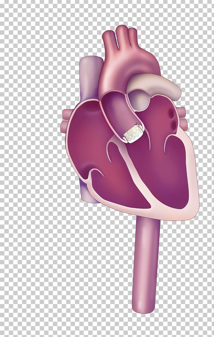 Percutaneous Aortic Valve Replacement Valvular Aortic Stenosis Heart Valve PNG, Clipart, Aorta, Aortic Valve, Aortic Valve Replacement, Artery, Cardiac Surgery Free PNG Download