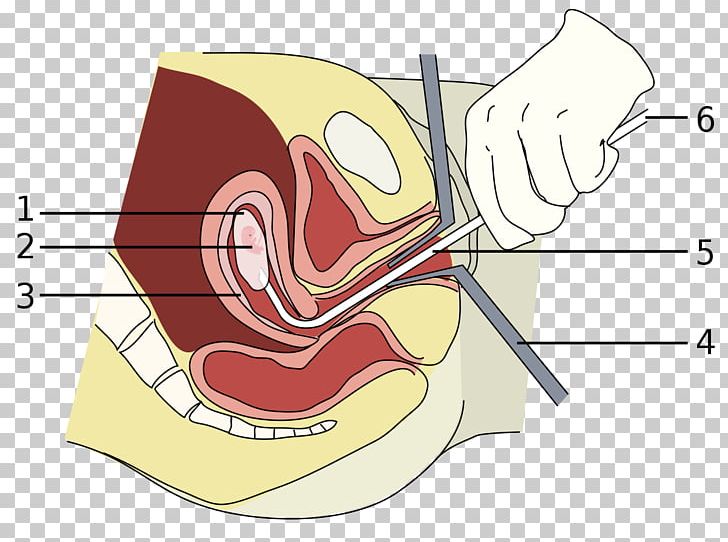 Vacuum Aspiration Miscarriage Abortion Surgery Dilation And Curettage PNG, Clipart, Angle, Area, Arm, Aspiration, Cartoon Free PNG Download