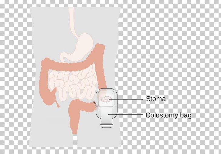Colostomy Stoma Ileostomy Surgery Ostomy Pouching System PNG, Clipart, Abdomen, Arm, Bag, Bowel Resection, Colorectal Cancer Free PNG Download