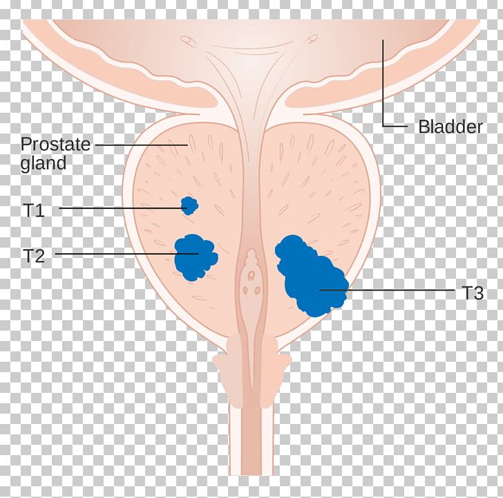 Prostate Cancer Staging Carcinoma In Situ PNG, Clipart, Angle, Cancer ...