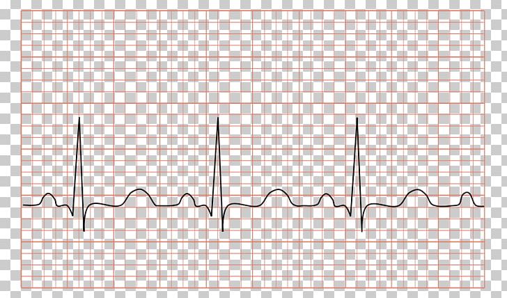 Electrocardiography Sinus Tachycardia Heart Rate PNG, Clipart,  Free PNG Download