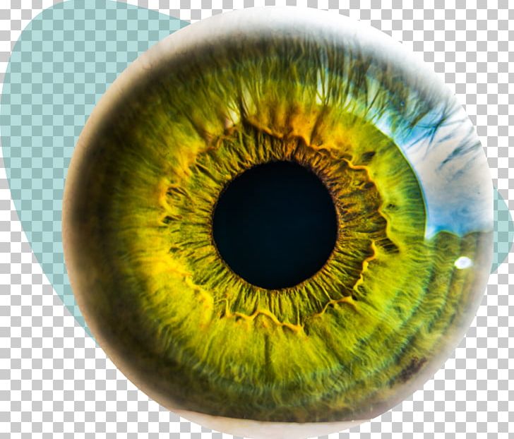 Eye Surgery Eye Injury LASIK Keratoconus PNG, Clipart, Blepharospasm, Closeup, Color, Disease, Dry Eye Syndrome Free PNG Download