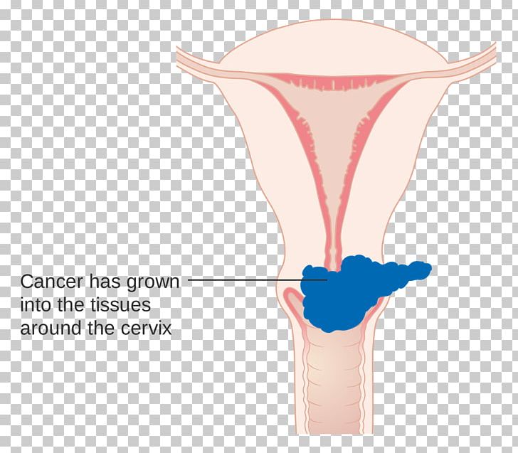 Cervical Cancer Staging Cervix PNG, Clipart, Abdomen, Cancer, Cancer Research Uk, Cancer Staging, Cervical Free PNG Download