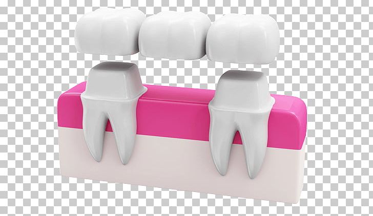 Bridge Dentistry Crown Dental Implant PNG, Clipart, Abutment, Bridge, Chair, Crown, Dental Free PNG Download