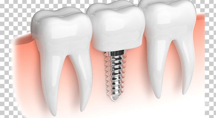 Dental Implant Dentistry Tooth Dental Restoration PNG, Clipart, Body Jewelry, Cadcam Dentistry, Crown, Dental, Dental Implant Free PNG Download