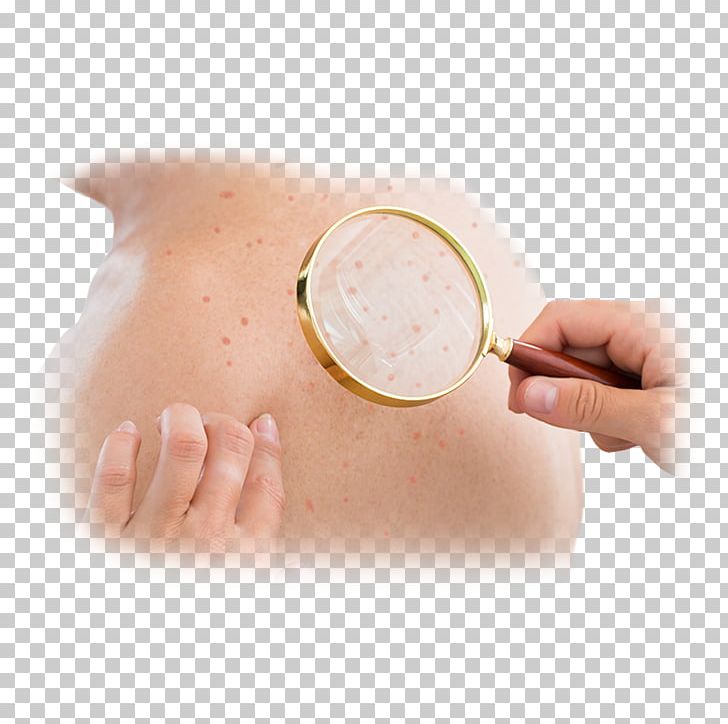 Dermatology Skin Cancer Medicine Disease PNG, Clipart, Cancer Medicine, Cutaneous Condition, Dermatology, Disease, Medical Diagnosis Free PNG Download