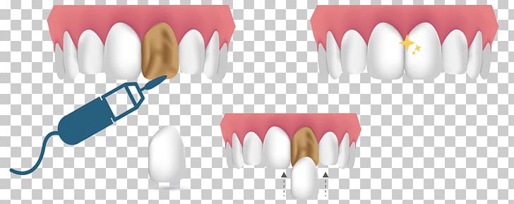Cosmetic Dentistry Veneer Dental Composite Human Tooth PNG, Clipart, Abrasion, Aesthetics, Coating, Cosmetic Dentistry, Cutlery Free PNG Download