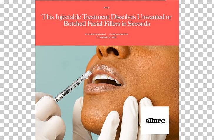Lip Augmentation Hyaluronic Acid Injectable Filler Restylane PNG, Clipart, Advertising, Brand, Cheek, Chin, Cosmetic Dentistry Free PNG Download