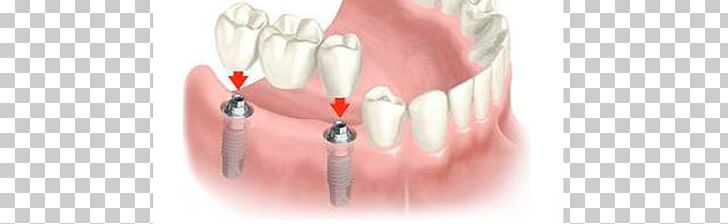 Dental Implant Dentistry Bridge Dentures PNG, Clipart, Bridge, Cosmetic Dentistry, Crown, Dental Implant, Dental Surgery Free PNG Download