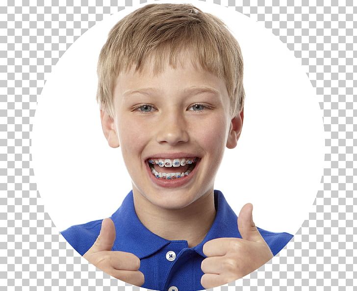 Orthodontics Dentistry Dental Braces Tooth American Association Of Orthodontists PNG, Clipart, Adjust, Boy, Braces, Cheek, Child Free PNG Download