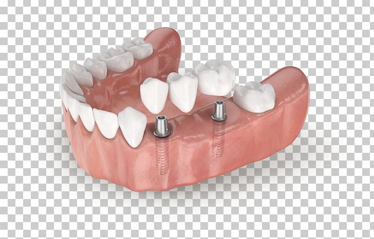 Tooth Jaw Dentures Dental Implant LASAK PNG, Clipart, Abutment, Bone, Crown, Dental Implant, Dentistry Free PNG Download