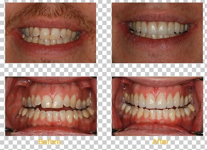 Tooth Whitening Cosmetic Dentistry Veneer PNG, Clipart, Bridge, Clear Aligners, Cosmetic Dentistry, Dental Braces, Dental Surgery Free PNG Download