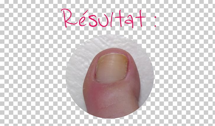 Nail Foot Cuticle Cuticule Onychomycosis PNG, Clipart, Cuticle, Cuticule, Finger, Foot, Hand Free PNG Download