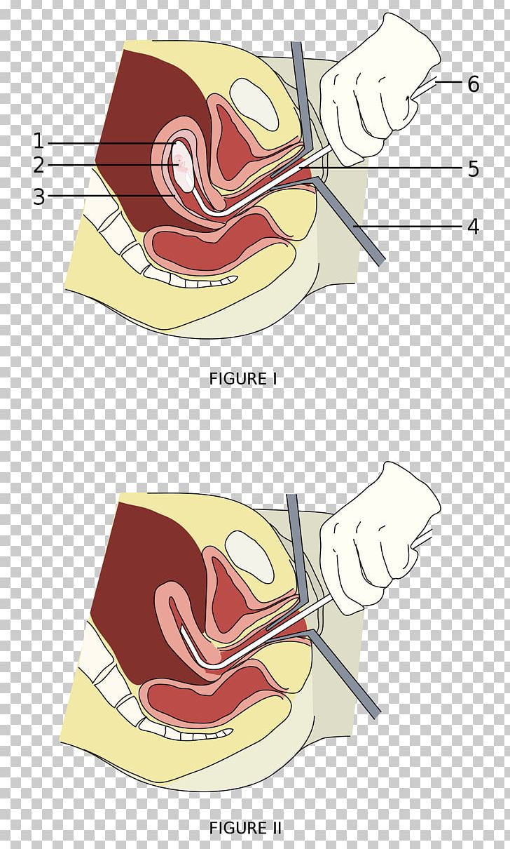 Vacuum Aspiration Surgery Abortion Miscarriage Therapy PNG, Clipart, Abortion, Angle, Arm, Art, Cartoon Free PNG Download