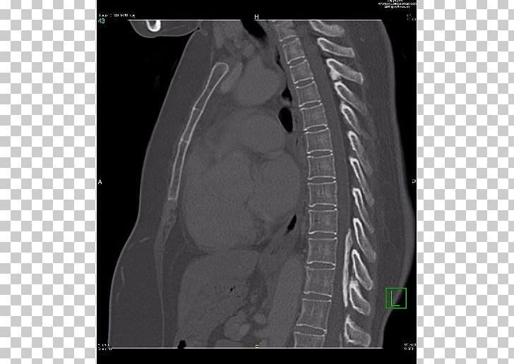 Radiology Autosomal Dominant Polycystic Kidney Disease Radiopaedia Medical Diagnosis PNG, Clipart, Automotive Tire, Automotive Wheel System, Auto Part, Computed Tomography, Cyst Free PNG Download