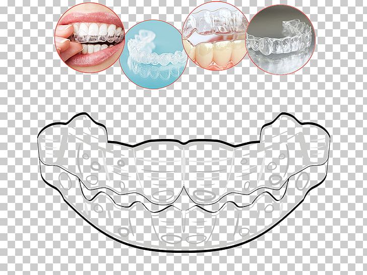 Tooth Clear Aligners Orthodontics Therapy Mouth PNG, Clipart, Clear Aligners, Gutters, Human Body, Invisalign, Invisibility Free PNG Download