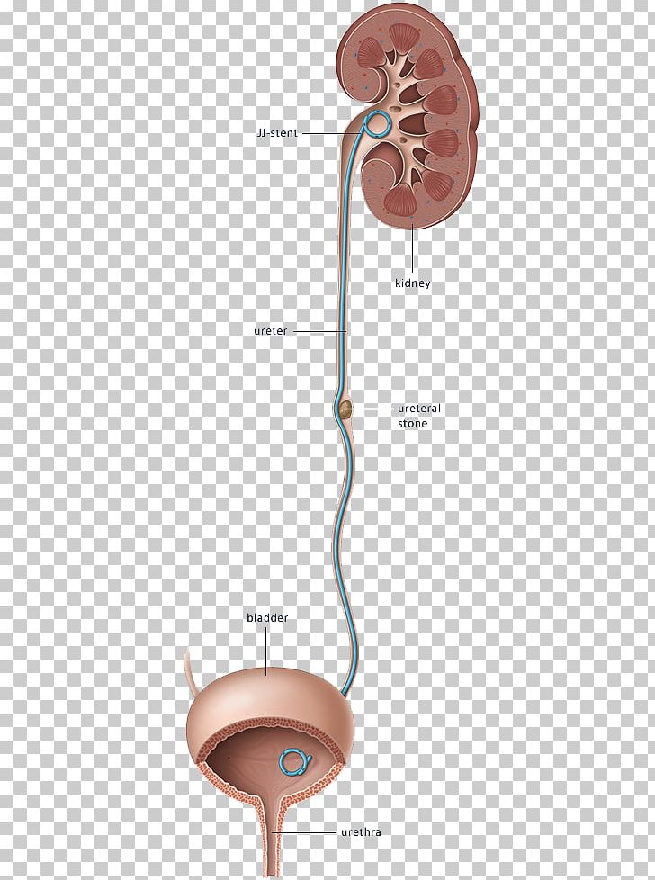 Ureteric Stent Stenting Excretory System Kidney PNG, Clipart, Anatomy, Cystoscopy, Human Body, Hydronephrosis, Interventional Radiology Free PNG Download