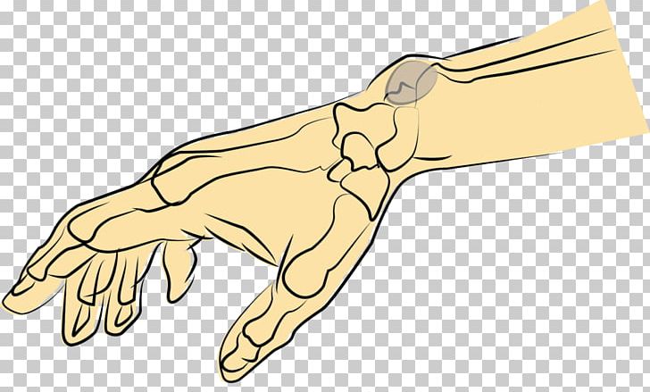 Thumb Synovial Cyst Hand Synovial Membrane PNG, Clipart, Ankle, Arm, Artwork, Cause, Cyst Free PNG Download