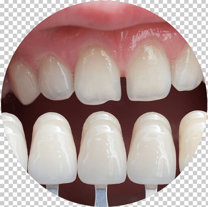 Veneer Cosmetic Dentistry Bridge PNG, Clipart, Bridge, Cosmetic Dentistry, Crown, Dental Implant, Dental Impression Free PNG Download