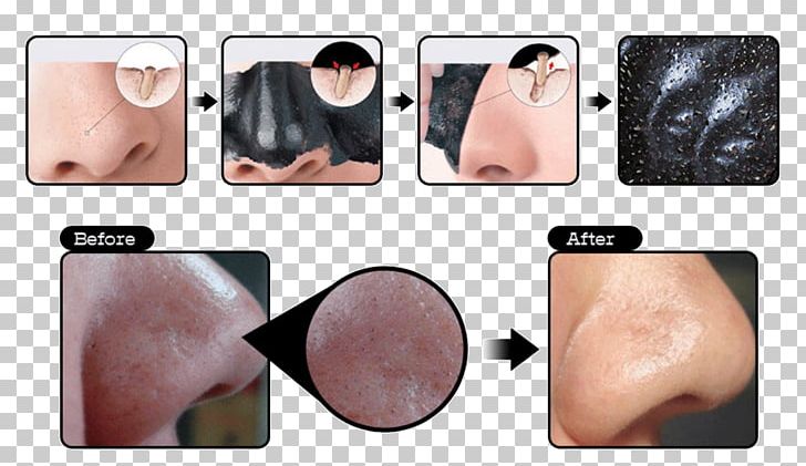 Comedo Mask Facial Cleanser Acne PNG, Clipart, Acne, Art, Blackhead, Black Mask, Cheek Free PNG Download