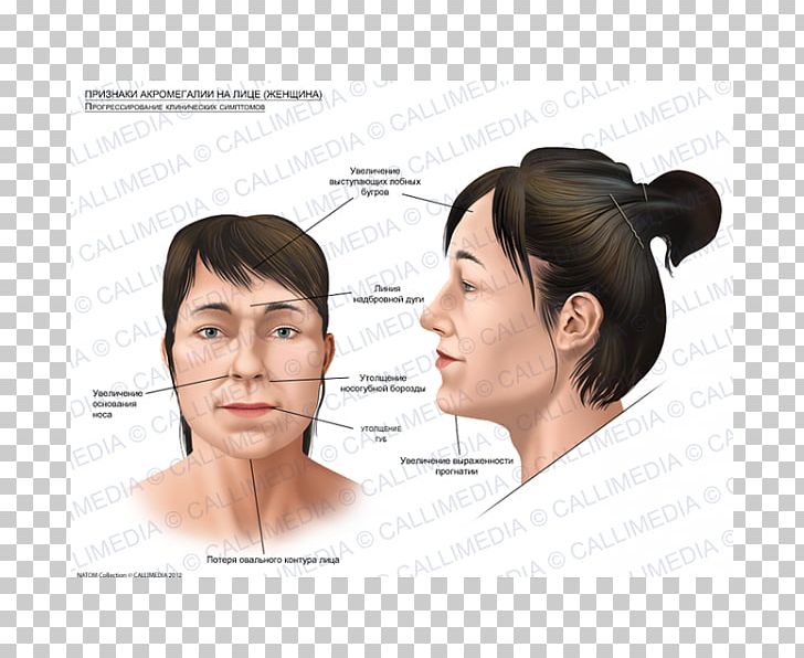 Acromegaly Face Skull Bossing Symptom Gigantism PNG, Clipart, Acromegaly, Cheek, Chin, Ear, Endocrinology Free PNG Download