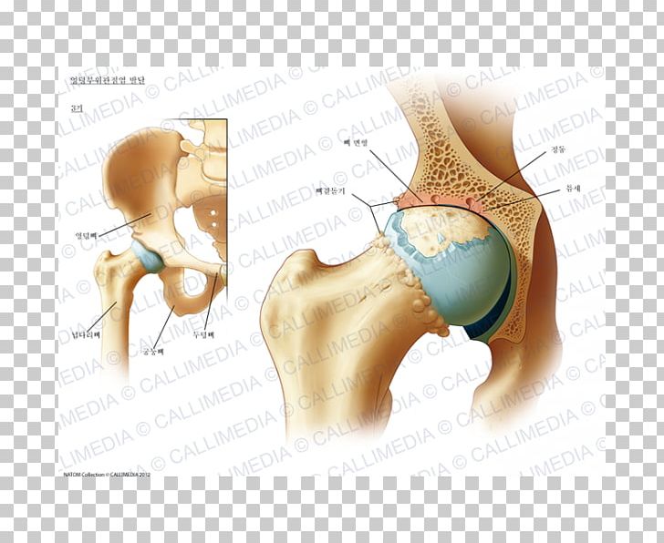 Hip Arthritis Shoulder Rheumatology Coxarthrosis PNG, Clipart, Anatomy, Arm, Arthritis, Buttocks, Chest Free PNG Download