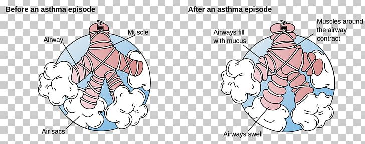 Asthma Bronchus Dyspnea Bronchospasm Disease PNG, Clipart, Area, Breathing, Bronchospasm, Bronchus, Chronic Condition Free PNG Download