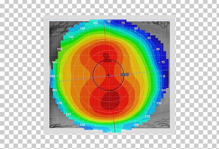 Corneal Topography Keratoconus Contact Lenses PNG, Clipart, Circle, Contact Lenses, Cornea, Corneal Limbus, Corneal Topography Free PNG Download