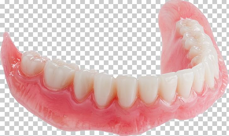 Tooth Dentures Mandible Dental Arch Paper Mill Dental PNG, Clipart, Allon4, Dental Arch, Dental Implant, Dentist, Dentistry Free PNG Download