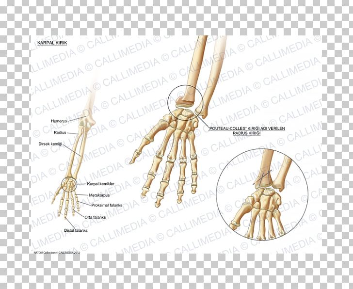 Bone Fracture Carpal Bones Wrist Pisiform Bone PNG, Clipart, Ache, Bone, Bone Fracture, Carpal Bones, Carpal Tunnel Syndrome Free PNG Download