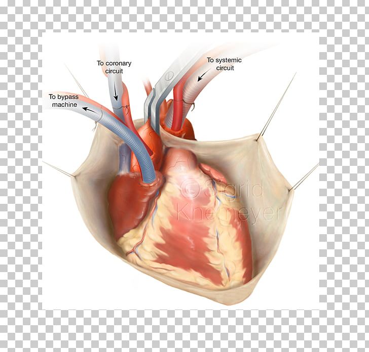Coronary Artery Bypass Surgery Vascular Bypass Off-pump Coronary Artery Bypass Coronary Artery Disease PNG, Clipart, Artery, Bypass, Bypass Surgery, Cardiovascular Disease, Coronary Arteries Free PNG Download