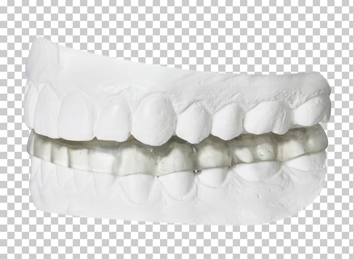Temporomandibular Joint Dysfunction Splint Dentist Orthodontics PNG, Clipart, Appliances, Bruxism, Dental Laboratory, Dentist, Dentistry Free PNG Download