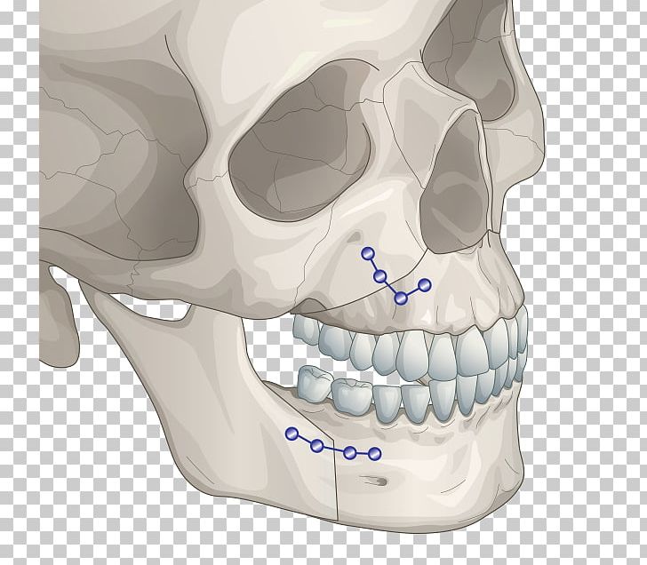 Jaw Orthognathic Surgery Chin Plastic Surgery PNG, Clipart, Alaleuanluu, Bone, Chin, Face, Facial Skeleton Free PNG Download
