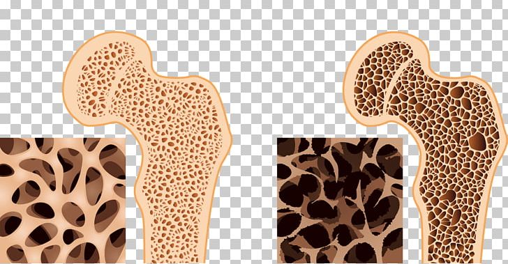 Bone Density Osteoporosis Bone Health Osteopenia PNG, Clipart, Back Pain, Bone, Bone Density, Bone Disease, Bone Fracture Free PNG Download