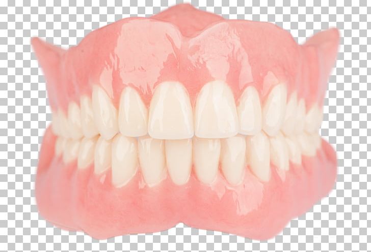 Tooth Dentures Dentistry Dental Laboratory PNG, Clipart, Bridge, Crown, Dental Implant, Dental Laboratory, Dental Restoration Free PNG Download