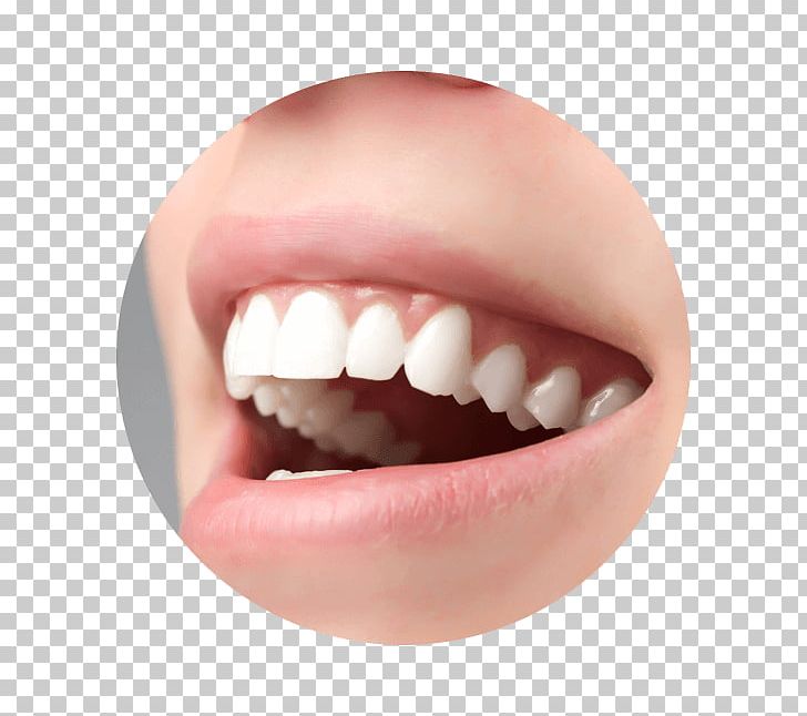 Crown Ceramic Tooth Veneer Dentistry PNG, Clipart, Aesthetics, Ceramic, Cermet, Chin, Closeup Free PNG Download