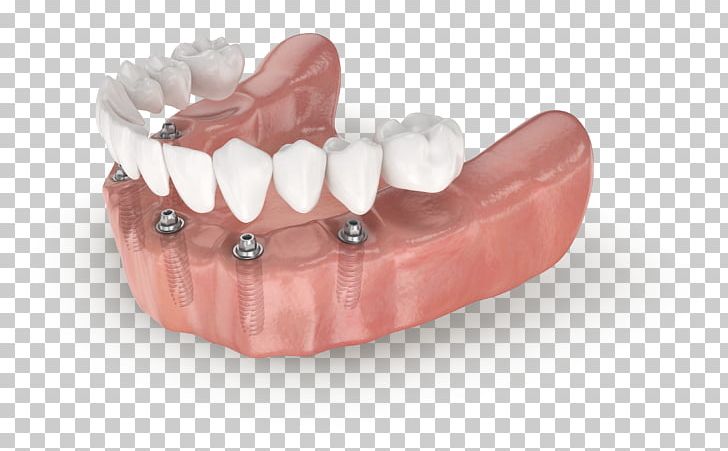 Tooth All-on-4 Dental Implant Dentistry Edentulism PNG, Clipart, All On 4, Allon4, Bridge, Dental Implant, Dentistry Free PNG Download