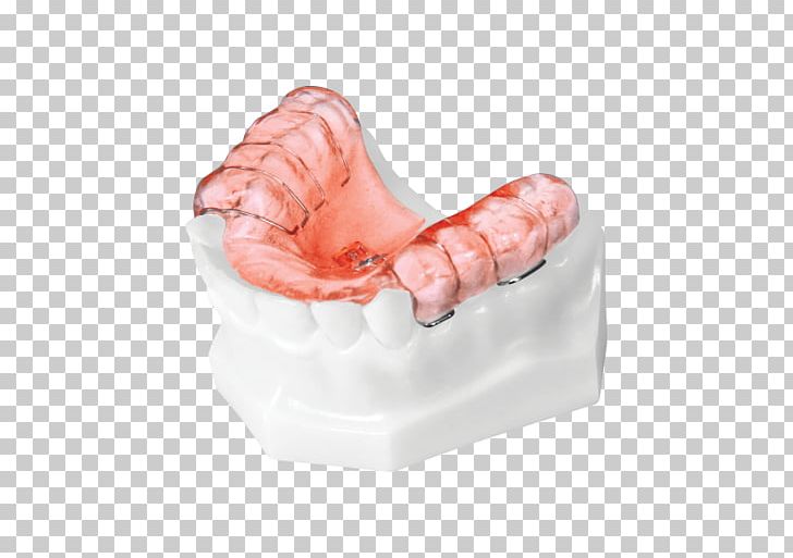 Tooth Orthodontics Home Appliance Orthodontic Technology Product Design PNG, Clipart, Canine Tooth, Competition, Crossbite, Finger, Hand Free PNG Download
