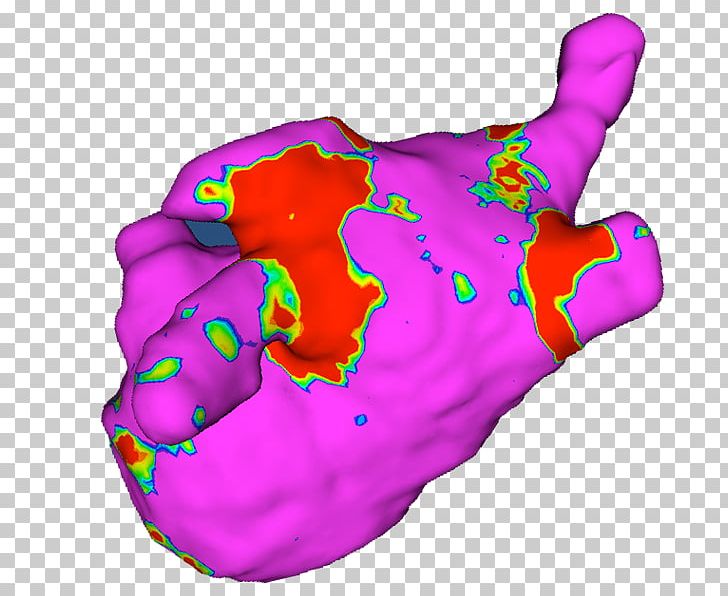 Atrial Fibrillation Heart Arrhythmia Atrial Flutter Paroxysmal Tachycardia PNG, Clipart, 13 Y, Ada, Atrial Fibrillation, Atrial Flutter, Atrium Free PNG Download