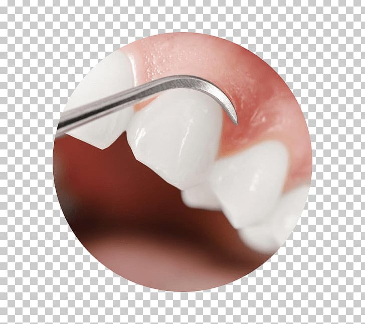 Gums Periodontal Disease Gingivitis Gingival Recession Dental Calculus PNG, Clipart, Bleeding On Probing, Dental Calculus, Dental Plaque, Dentist, Dentistry Free PNG Download